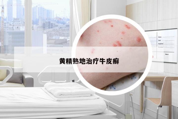 黄精熟地治疗牛皮癣