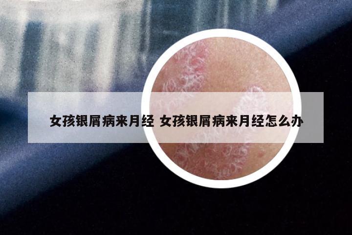 女孩银屑病来月经 女孩银屑病来月经怎么办