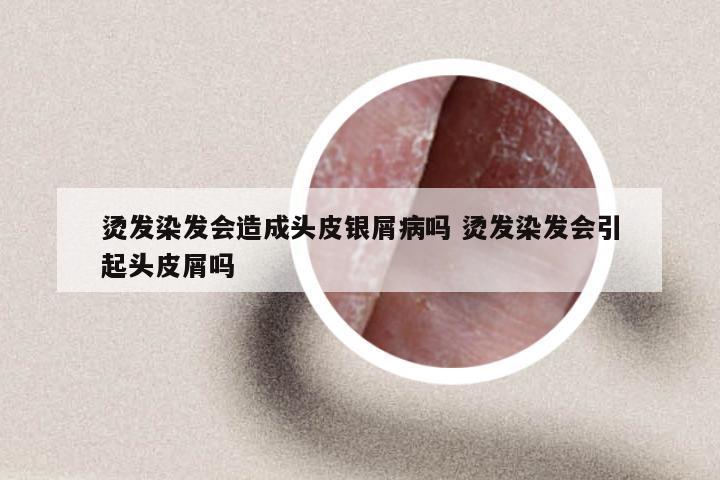 烫发染发会造成头皮银屑病吗 烫发染发会引起头皮屑吗