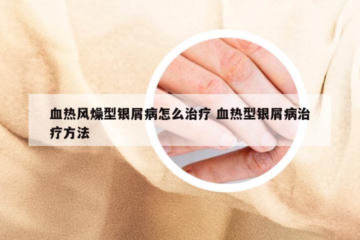 血热风燥型银屑病怎么治疗 血热型银屑病治疗方法