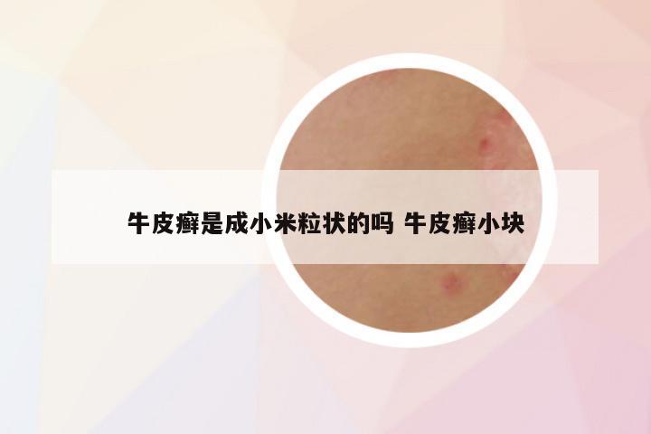 牛皮癣是成小米粒状的吗 牛皮癣小块