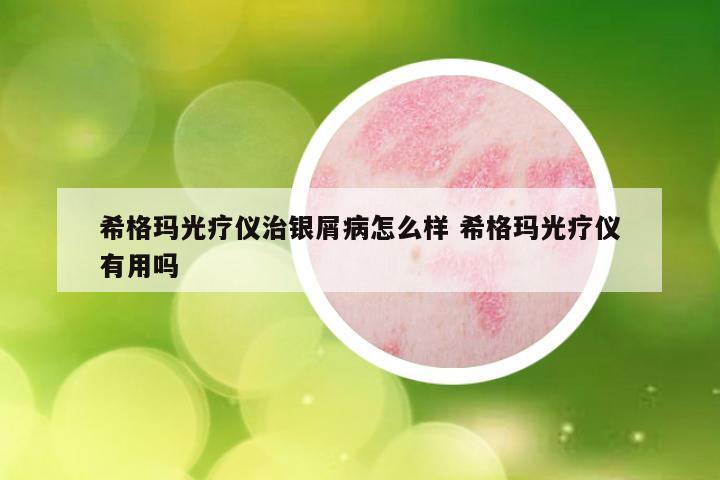 希格玛光疗仪治银屑病怎么样 希格玛光疗仪有用吗