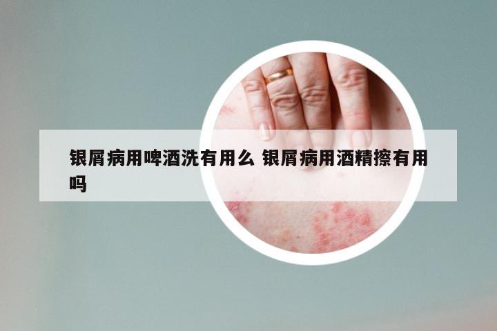 银屑病用啤酒洗有用么 银屑病用酒精擦有用吗