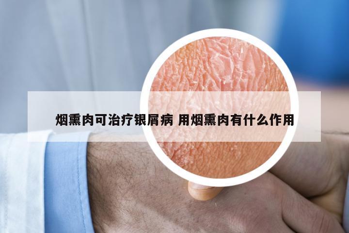 烟熏肉可治疗银屑病 用烟熏肉有什么作用