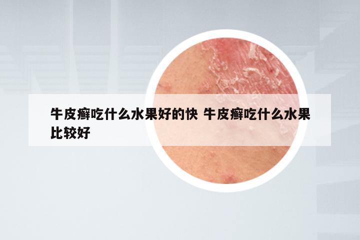 牛皮癣吃什么水果好的快 牛皮癣吃什么水果比较好