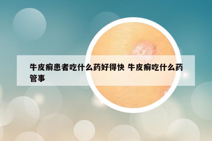 牛皮癣患者吃什么药好得快 牛皮癣吃什么药管事