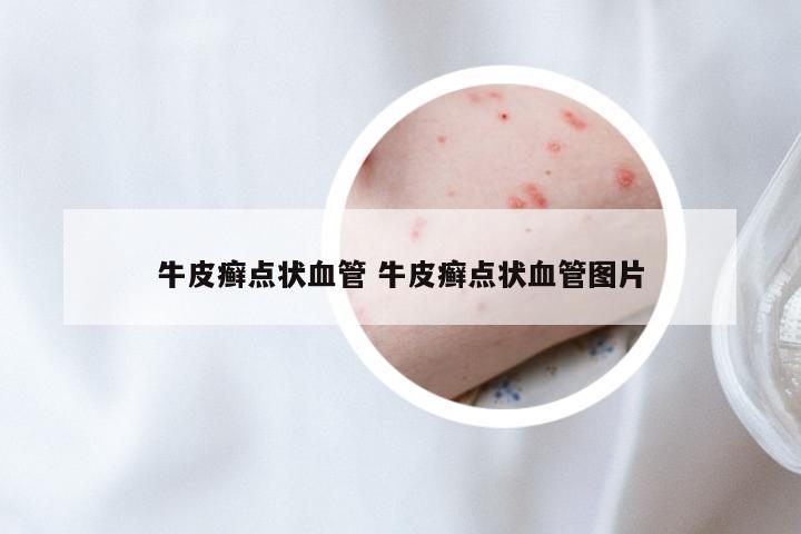 牛皮癣点状血管 牛皮癣点状血管图片