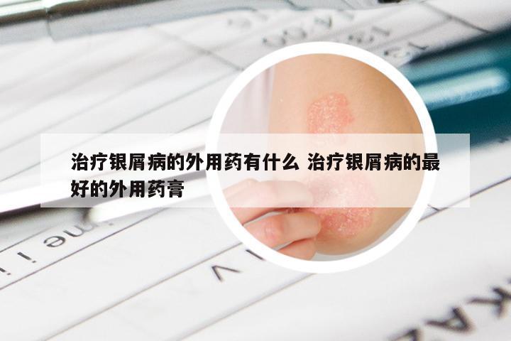 治疗银屑病的外用药有什么 治疗银屑病的最好的外用药膏