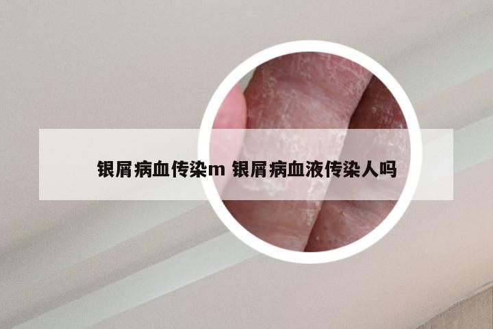 银屑病血传染m 银屑病血液传染人吗