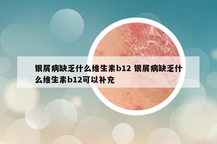 银屑病缺乏什么维生素b12 银屑病缺乏什么维生素b12可以补充
