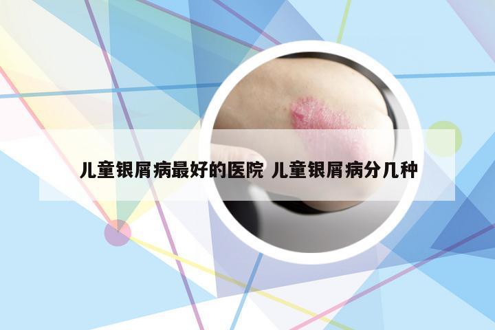 儿童银屑病最好的医院 儿童银屑病分几种