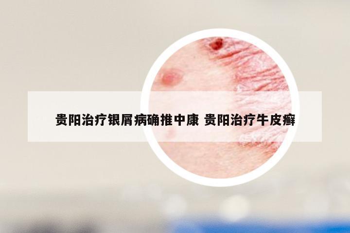 贵阳治疗银屑病确推中康 贵阳治疗牛皮癣