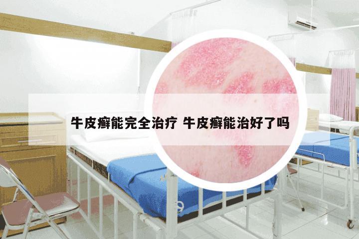牛皮癣能完全治疗 牛皮癣能治好了吗
